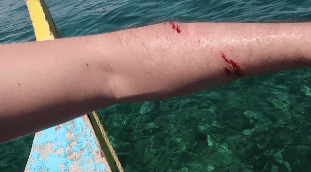 arm sliced by drone in the paradise of the philippines